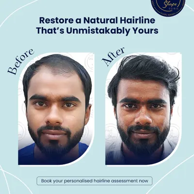 Restoring a natural hairline that is unmistakably yours. This before and after shows a significant improvement in density and a redefined hairline that frames the face naturally.