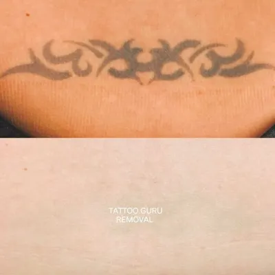 This tribal-style lower back tattoo has been significantly faded. This type of dense black ink work requires patience and several sessions to break down completely.