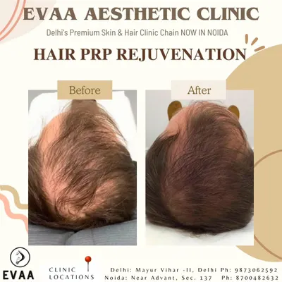 A clear before and after comparison showcasing significant hair regrowth and increased density on the crown area for a male client. This result was achieved through our customized Hair PRP Rejuvenation protocol, a non-surgical treatment for androgenetic alopecia.