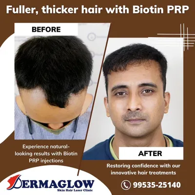 This before-and-after image shows the powerful effect of Biotin PRP injections. The treatment significantly improved hair density and restored the client's hairline, offering a non-surgical path to fuller hair.