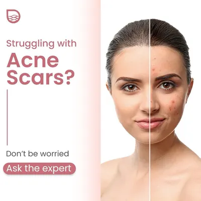 If you are struggling with acne scars, you are not alone. I can help you develop a personalized treatment plan to address your specific concerns and achieve smoother skin.