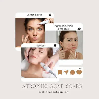 Atrophic acne scars, which appear as depressions in the skin, are a primary focus of my practice. Here, we explore how they form, the different types, and the advanced treatments I use to restore smoother skin texture.