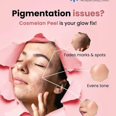For deep and stubborn pigmentation issues like melasma, the Cosmelan Peel is our go-to solution. This professional-grade treatment works by inhibiting melanin production to fade dark spots and deliver visible results for an even, radiant skin tone.