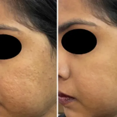 This before and after comparison demonstrates the power of the CO2 laser in treating atrophic acne scars. The patient's skin texture is visibly smoother and the scars are significantly less prominent after completing the recommended course of treatments.