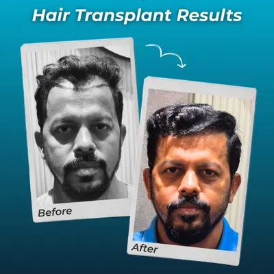 A clear view of a significant transformation. We focused on creating a dense, age-appropriate hairline that restores a youthful frame to the face, leading to a major boost in this patient's confidence.