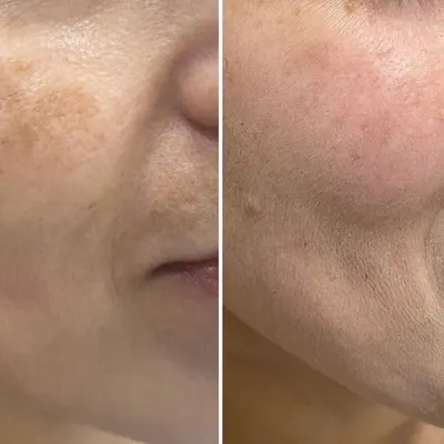 This transformation highlights the effectiveness of a structured approach to hyperpigmentation. By pairing clinical procedures with a diligent home routine, we were able to clear these patches and restore a uniform skin tone.