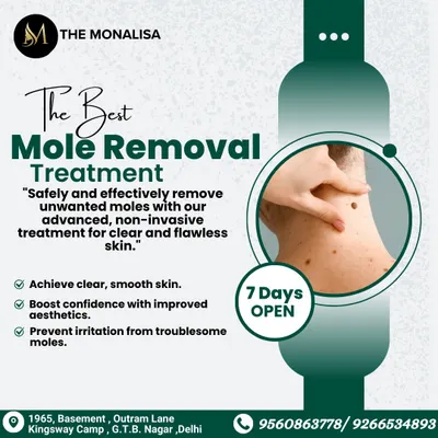 We provide the best mole removal treatment using advanced, non-invasive methods. This procedure safely removes unwanted moles to give you clear, smooth skin and prevent irritation from troublesome spots.