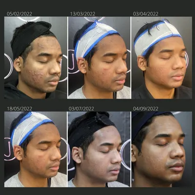 This patient's transformation over seven months involved a combination of Microneedling RF, CO2 laser, and carbon peels. Tracking progress session by session allows us to adjust the treatment plan for the most effective acne and scar revision possible.
