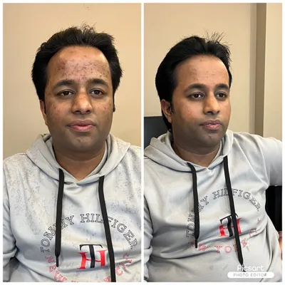 My expertise is creating a natural, clean look. This before-and-after comparison shows how I use corrective makeup techniques to even out skin tone and conceal acne, ensuring you look sharp and confident in person and on camera.