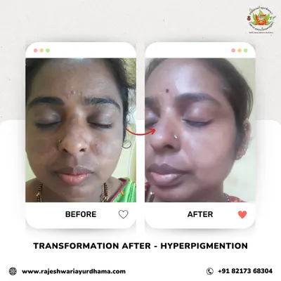 A clear example of my hyperpigmentation treatment. I use specific herbal formulations and Ayurvedic cosmetology techniques to lighten dark spots and melasma, resulting in a clearer and more even facial complexion.