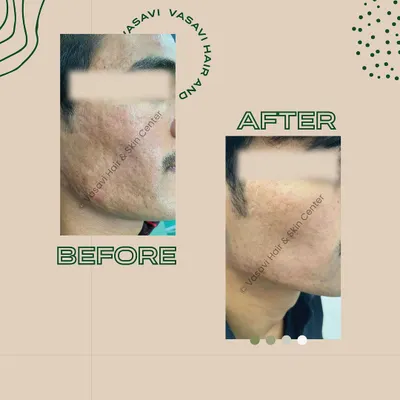 This before-and-after comparison demonstrates the significant improvement possible for deep, textured acne scars. The patient on the left presented with a combination of atrophic scars. Through a personalized treatment plan involving multiple sessions, we achieved the smoother, more even skin texture you see on the right, restoring both the skin's surface and the patient's confidence.