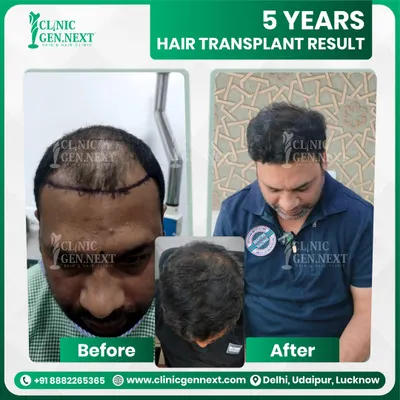 This result after 5 years shows the longevity and natural direction of the hair we achieve. The coverage on the crown is mature and blends perfectly, which is crucial for a real-world, authentic look.