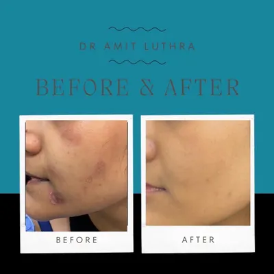 Unsightly acne scars don't have to be permanent. This before and after shows the significant improvement in skin texture and scar reduction possible with my tailored resurfacing treatments.