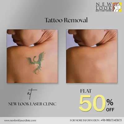 This before and after comparison clearly demonstrates the power of our laser treatment on a colored tattoo. The image on the right shows the skin after several sessions, with the ink almost completely gone.