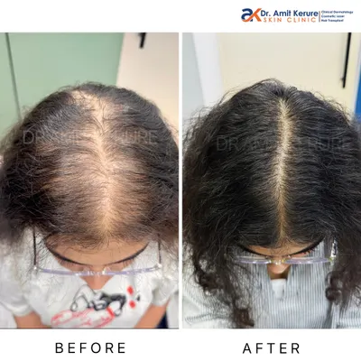 This before-and-after image shows a significant improvement in hair density for a female patient. This result was achieved with non-surgical treatments that stimulate dormant hair follicles, effectively reversing the signs of thinning.