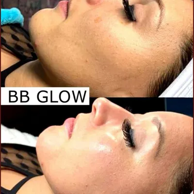 A clear demonstration of the BB Glow effect. Notice how the skin tone becomes more even, redness is reduced, and the overall complexion is brighter and more luminous after the treatment.