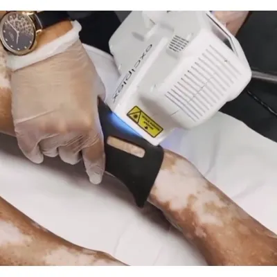 This image shows the application of an Excimer laser, a targeted phototherapy treatment for vitiligo. This advanced technology allows me to deliver a concentrated beam of UVB light directly to the affected patches, stimulating re-pigmentation without exposing the healthy skin.