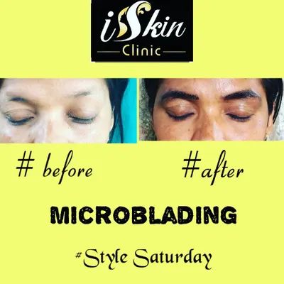 A direct comparison showing the impact of our microblading service. We transformed sparse eyebrows into a well-defined, fuller shape that looks natural and enhances the patient's features.