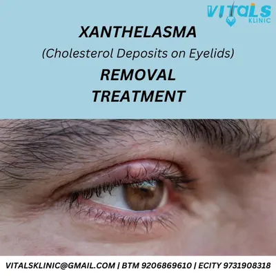 A close-up view of Xanthelasma on the eyelid. This graphic explains the condition and highlights that we provide safe and effective removal treatments to restore a clear and smooth appearance to the eye area.