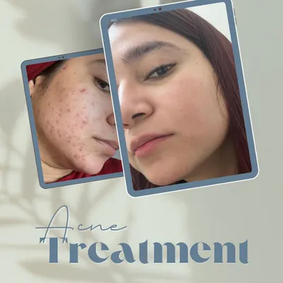 A powerful before and after of a client's successful acne treatment journey. We focused on a multi-step approach to clear breakouts and then address the resulting texture and marks.