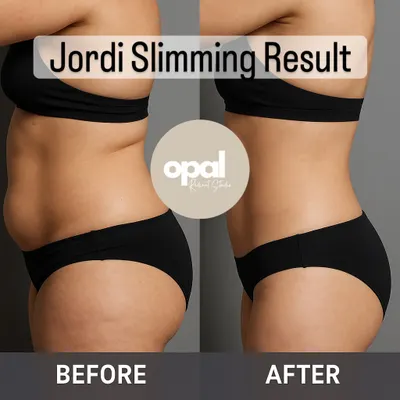 This before and after image showcases a typical result from a series of Jordi Shape sessions. Notice the visible reduction in the abdomen and love handles, leading to a more defined body shape. My goal is to help you tackle these stubborn areas that diet and exercise sometimes cannot.