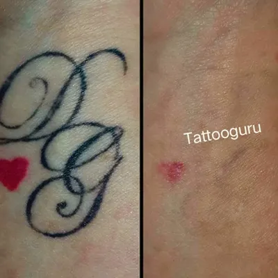 This tattoo had both black script and a red heart. You can see in the after photo that while the black ink is gone, a faint trace of the red pigment remains, which is typical for red ink removal.