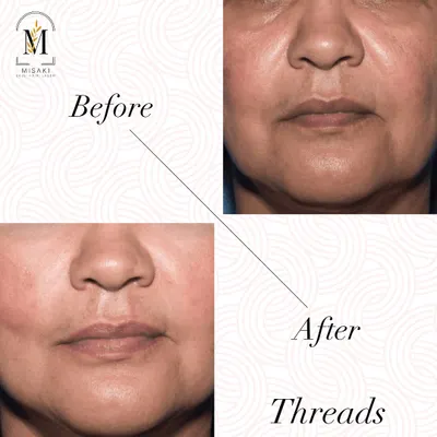 This before and after image shows the subtle yet effective lift achieved with threads. Notice the improvement in the lower face and the softening of lines around the mouth for a rejuvenated look.