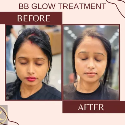 This client received our BB Glow treatment, resulting in a visibly brighter and more even skin tone. This service is ideal for reducing the appearance of discoloration and achieving a lasting glow.