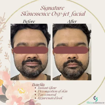 This client wanted to tackle dullness and tan. The before-and-after photos show the immediate brightening and rejuvenating effect of my signature Oxy-jet Medi-facial, which left his skin looking visibly refreshed and glowing.