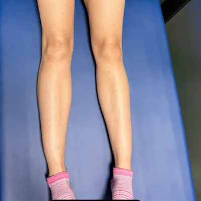 This "before" image shows significant quadriceps atrophy following an ACL and meniscus injury. This muscle loss is a common consequence of such injuries and is the starting point for our targeted rehabilitation process.