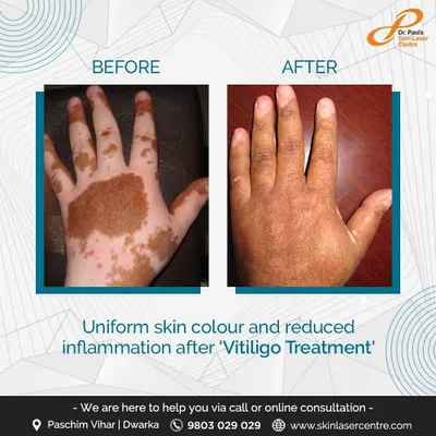 This patient's hand shows a remarkable improvement after vitiligo treatment, resulting in a more uniform skin color. My goal is always to restore color and reduce inflammation, helping you feel more confident in your skin.