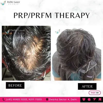 Another successful hair restoration using a combination of PRP and PRFM therapy. The 'before' photo shows significant thinning at the crown, and the 'after' photo displays a remarkable improvement in hair density and scalp coverage.