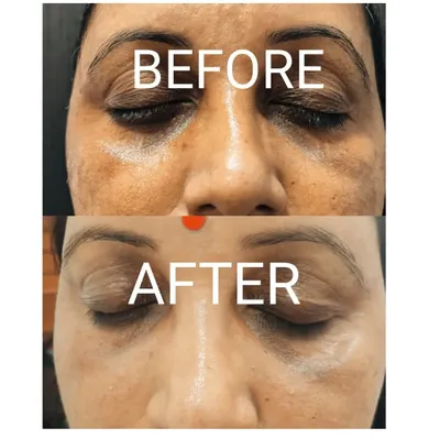 A dramatic reduction in under-eye pigmentation and fine lines after a personalized Dermafrac treatment plan. This shows how I target stubborn dark circles to reveal brighter, more youthful eyes.