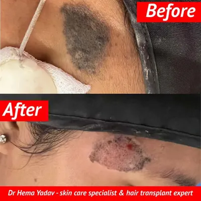 This patient came to me for the removal of a hairy nevus, a common type of birthmark. The 'after' photo shows the area immediately post-procedure. This kind of dermatological treatment can significantly improve skin texture and appearance.