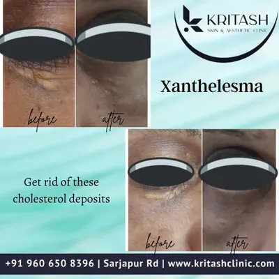These before-and-after images show the successful removal of Xanthelasma. These yellowish deposits of cholesterol under the skin can be safely and effectively treated in the clinic using procedures like radiofrequency ablation or CO2 laser.