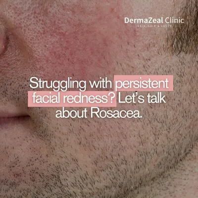 If you are struggling with persistent facial redness, it is important to consider that it might be Rosacea. This condition requires a specific approach to management and treatment, which starts with a professional diagnosis.