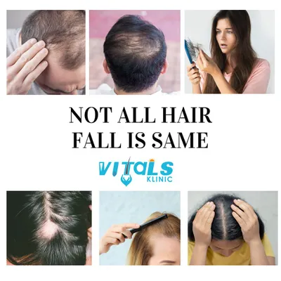 It is crucial to understand that not all hair fall is the same. This image collage shows different patterns of hair loss in men and women, emphasizing that the cause can range from genetic balding to diffuse thinning. A correct diagnosis is key to finding the right treatment.