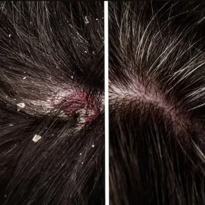 This before-and-after comparison clearly shows the effectiveness of a targeted dandruff treatment. On the left, you can see flakes and scalp inflammation, and on the right, a clear, healthy scalp after my prescribed medical treatment plan.