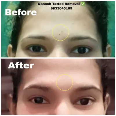 A clean before-and-after result of a permanent bindi tattoo removal. My goal is always to restore your skin, giving you a fresh start.