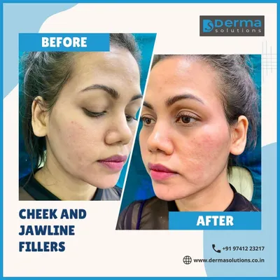 A well-defined facial structure can significantly enhance your profile. This before and after image demonstrates how I use cheek and jawline fillers to add contour and create a more sculpted, youthful look.