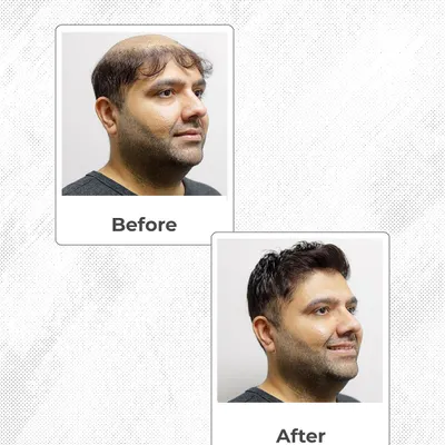 A side-profile view showing a significant hair transplant transformation. This patient regained not just his hairline but also his confidence. The 'after' photo highlights the density and natural flow of the newly grown hair.