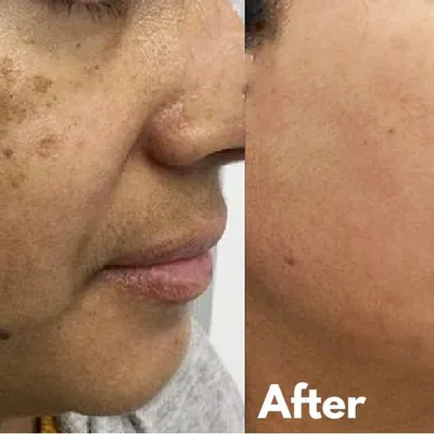 This is a powerful before-and-after of a patient with significant melasma. My treatment plan focused on a combination of advanced laser toning and a strict sun protection regimen to achieve this clear, even-toned result.