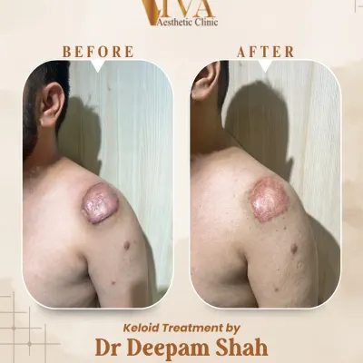 This patient came to me for a large, raised keloid on his shoulder. After just four sessions of our triple combination therapy, which includes injections, laser, and exosome massage, the keloid is significantly flatter and less noticeable. My goal is always to improve both the look and feel of the skin.