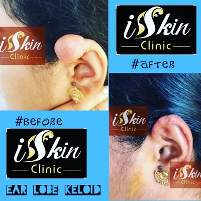 This patient presented with a large keloid on the earlobe, a common complication from piercings. Our surgical removal and earlobe repair procedure successfully restored the ear's normal appearance, highlighting our expertise in keloid treatment.