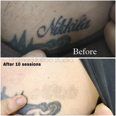 This before-and-after image shows the significant fading of a name tattoo after 10 sessions. My goal is to give you a clean slate, and this demonstrates the real, visible results of my professional laser removal process.