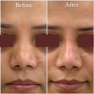 This before and after shows a liquid rhinoplasty to create a straighter and more defined nasal bridge. This is a great non-surgical option for refining the nose's appearance.
