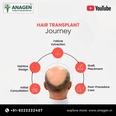 This infographic outlines the complete hair transplant journey. It starts with an initial consultation and hairline design, followed by follicle extraction, graft placement, and finally, post procedure care.