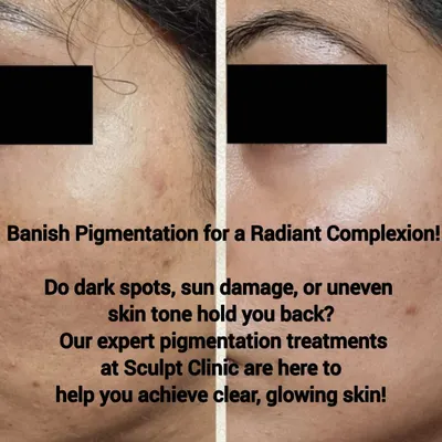 This before-and-after image demonstrates the effectiveness of our pigmentation treatments. We help banish dark spots and sun damage, creating a more even and radiant complexion for our clients.