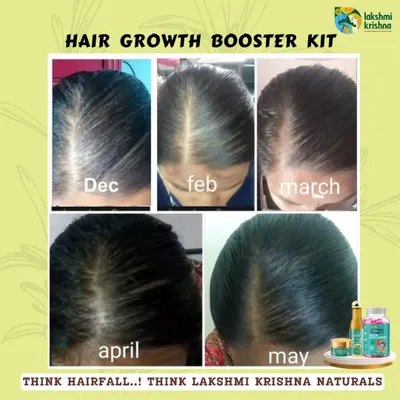 This before-and-after collage shows the real progress a customer made using our Hair Growth Booster Kit over several months. You can see the gradual but significant improvement in hair density from December to May.