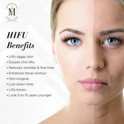 This visual clearly shows the transformative power of HIFU. It is a non-surgical way to lift saggy skin, reduce a double chin, and smooth fine lines, helping you look years younger with very low downtime.